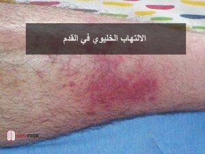 الالتهاب الخلوى ما هو وما هي أعراضه وعلاجه ويكي مصر