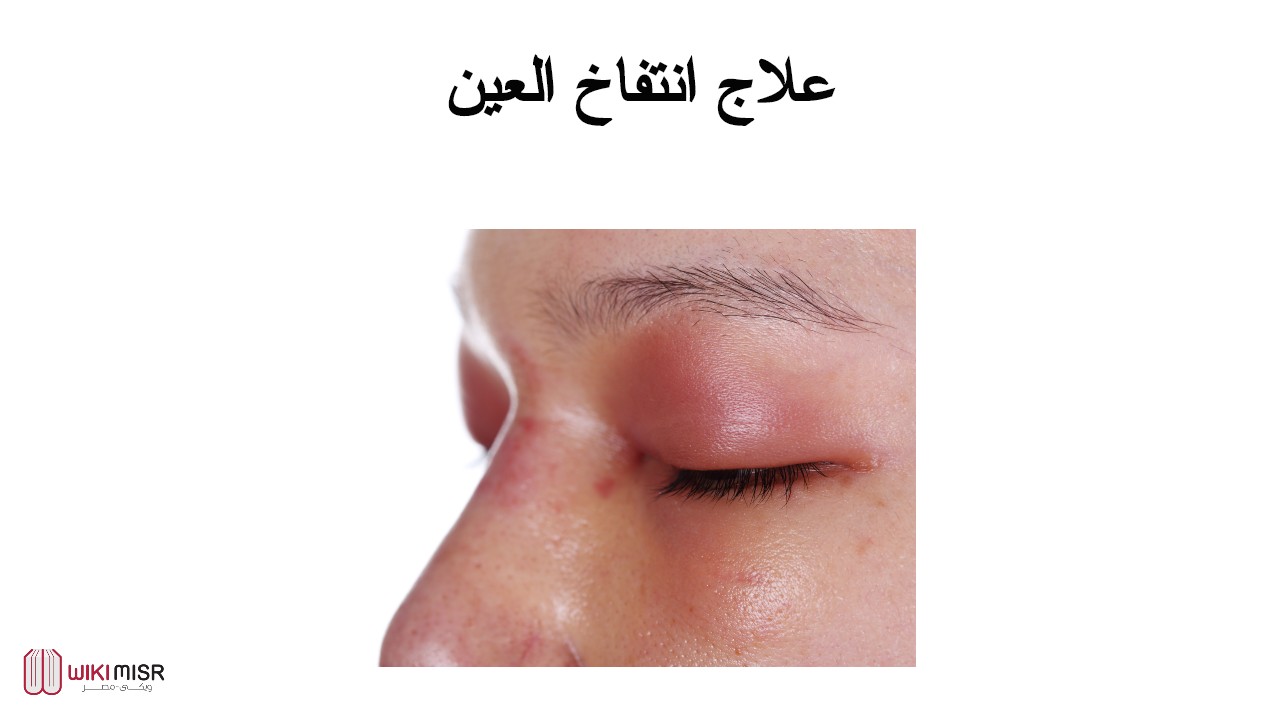 علاج انتفاخ العين