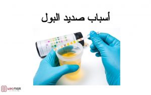 أسباب الإصابة بصديد البول والأعراض وأهم طرق العلاج