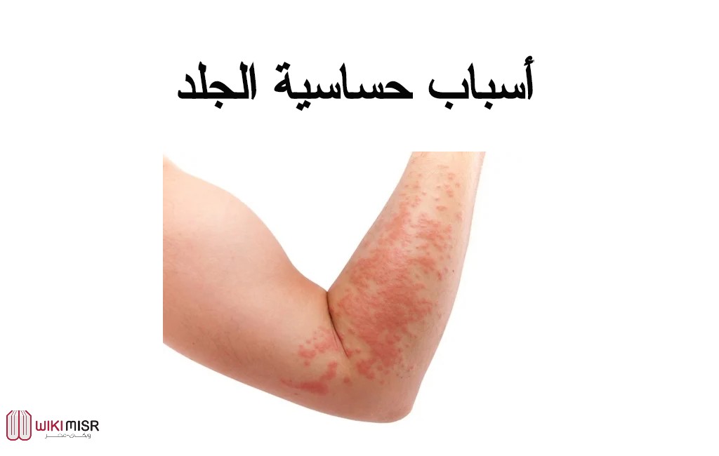 أسباب حساسية الجلد وأهم طرق العلاج
