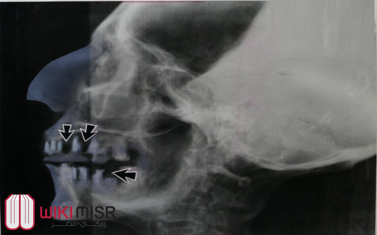 صورة بالأشعة لرأس مومياء رمسيس الثانى توضح إصابات أسنانه وفكه, ارشيف "جيمس هاريس" من فحوصات عام 1967.