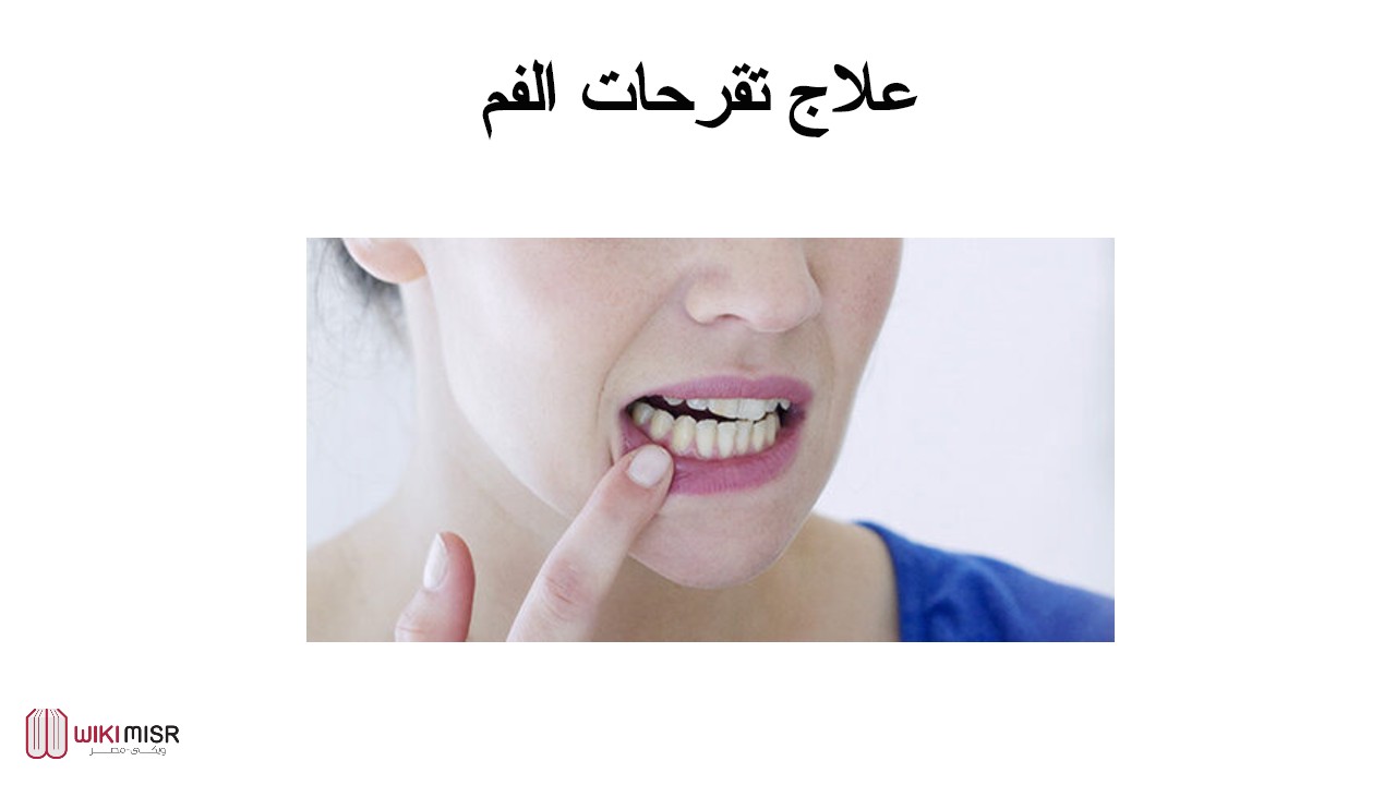 طرق علاج تقرحات الفم