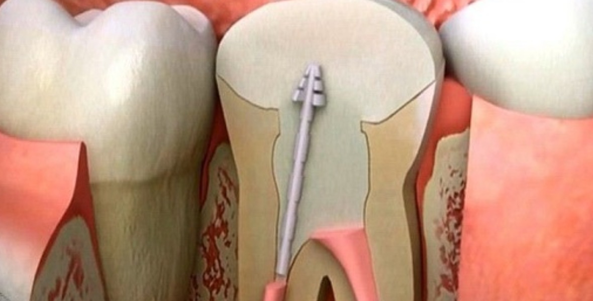 أعراض التهاب عصب الأسنان وطرق العلاج في المنزل