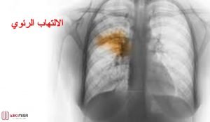 الالتهاب الرئوي