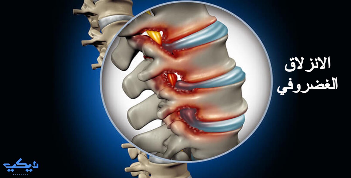 أعراض الانزلاق الغضروفي وأهم طرق العلاج