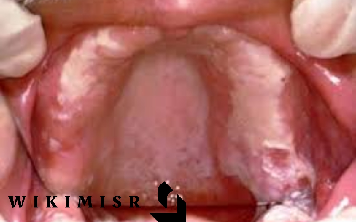 التهاب الفم وزيادة الفطريات