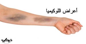 اللوكيميا