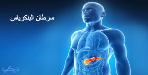 سرطان البنكرياس