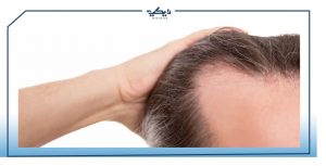 علاج الصلع الوراثي