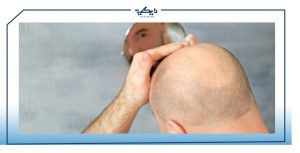علاج الصلع الوراثي