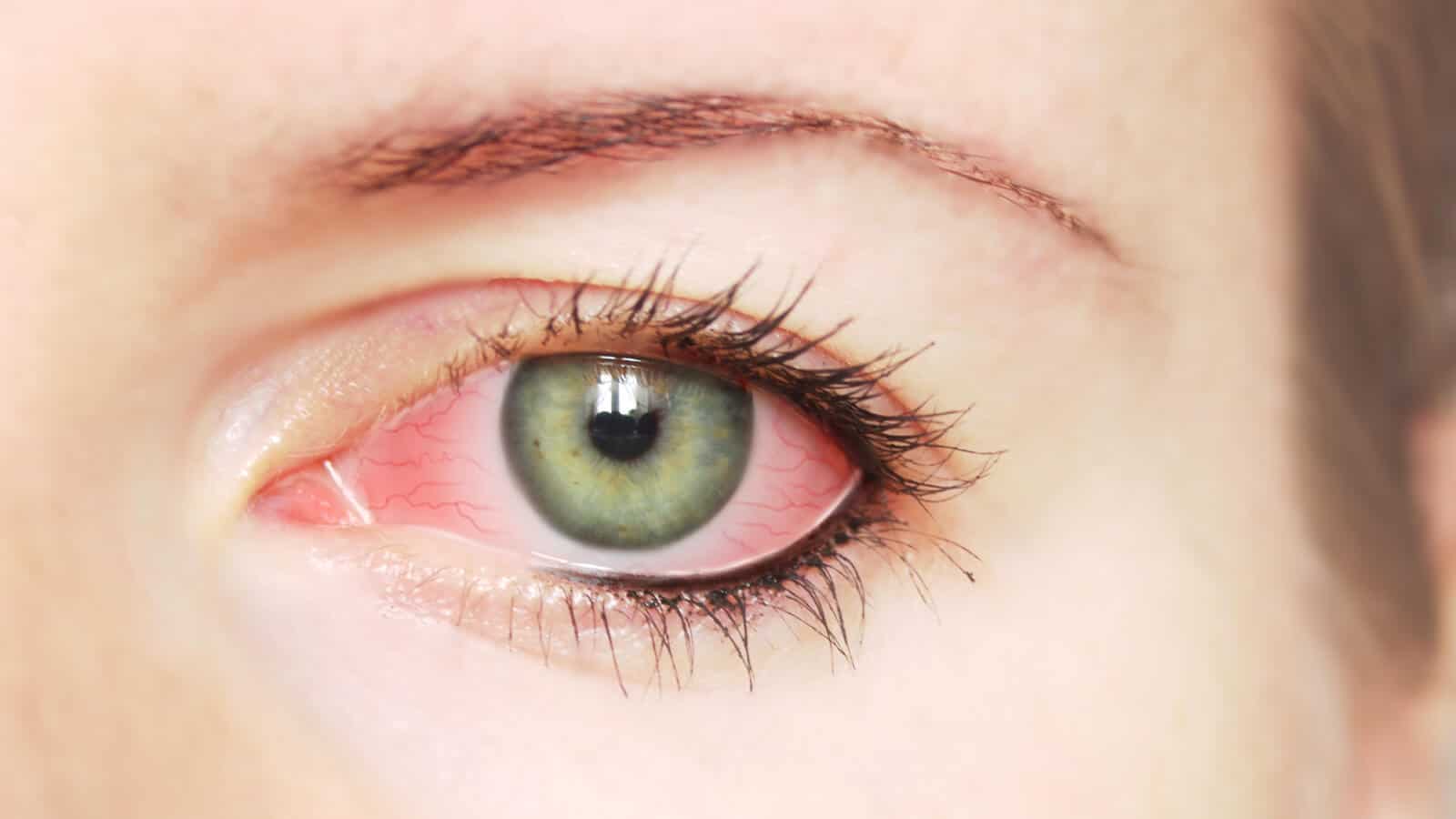 افضل علاج لجفاف العين الشديد