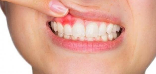خراج الاسنان أسباب علاجه وهل يمكن فقعه دون استشارة طبيب