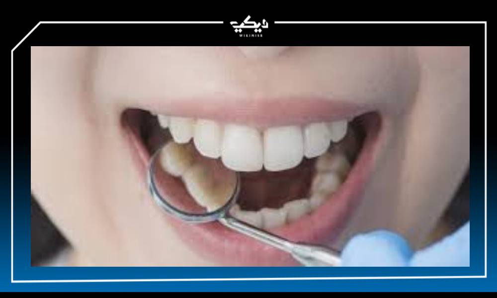 علاج تسوس الأسنان بالوصفات المنزلية الطبيعية