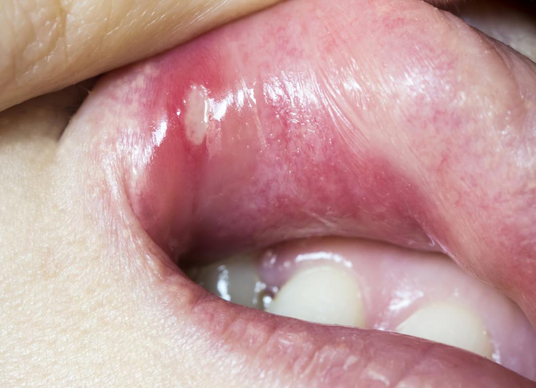 علاج قرحة الفم