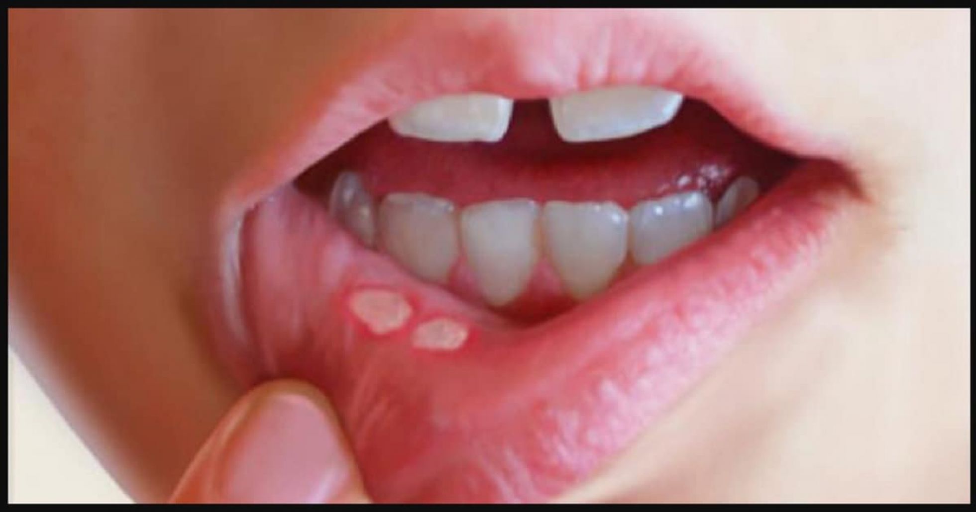 علاج قرحة الفم المتكررة .. أسباب تقرحات الفم