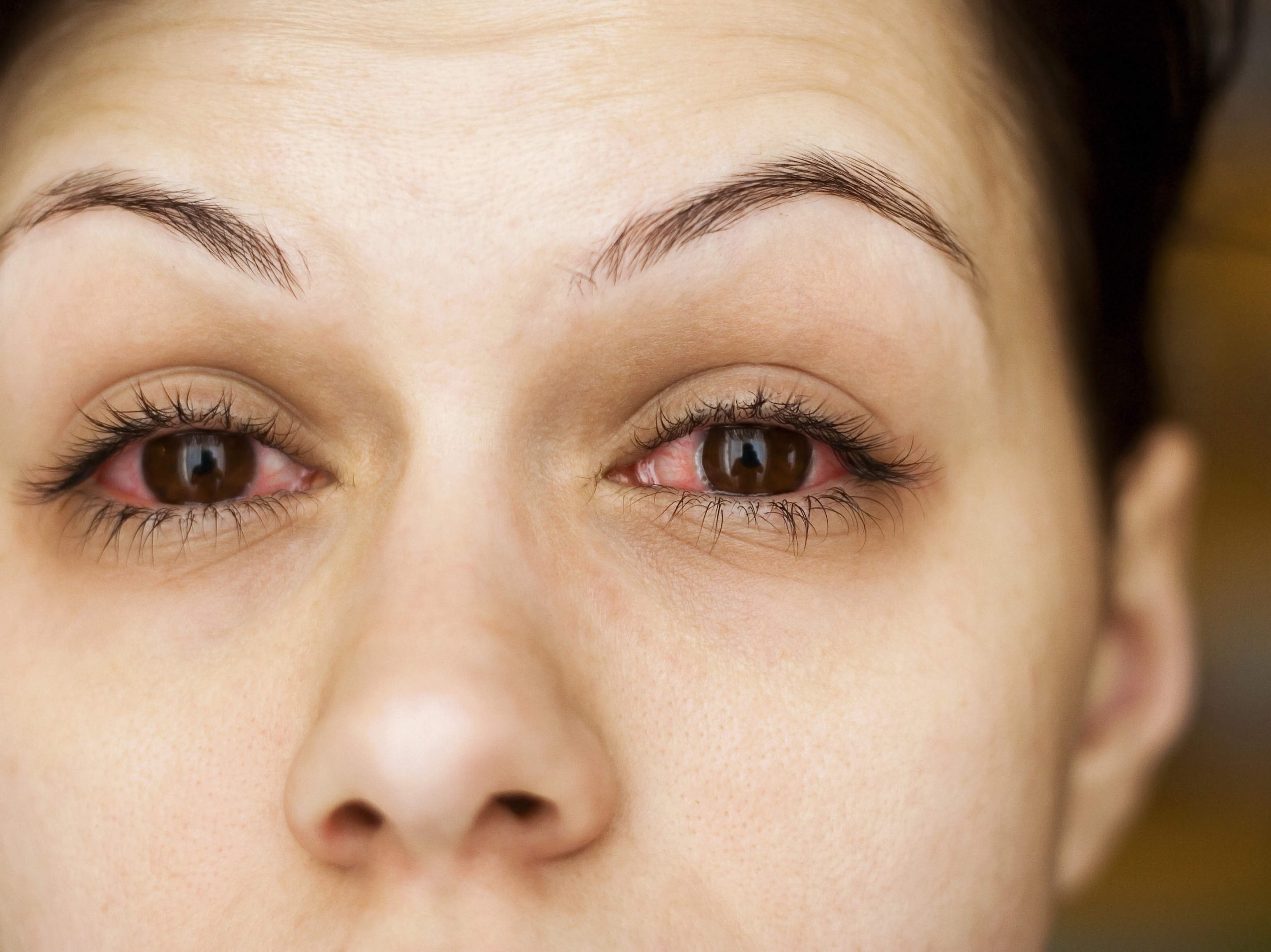 التخلص من التهاب العين من العدسات