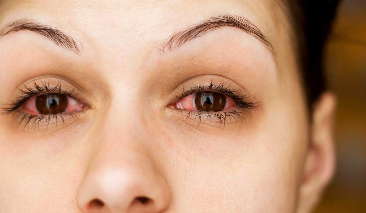 قطرة orchadexoline لعلاج التهاب العين وتقليل الاحمرار
