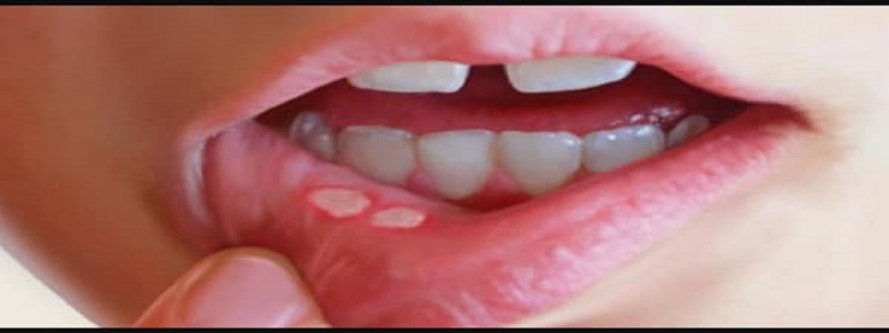    علاج تقرحات الفم