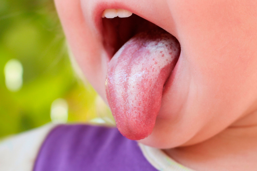 اسباب فطريات الفم وأعراضها المؤلمة