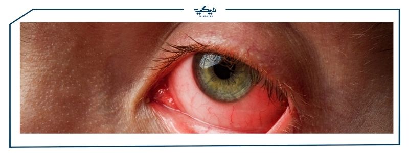 تعرف على ادوية التهاب العين !