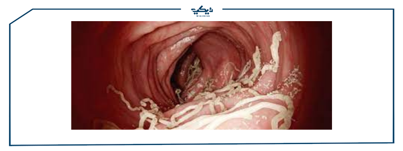 أدوية علاج الديدان وآثارها الجانبية