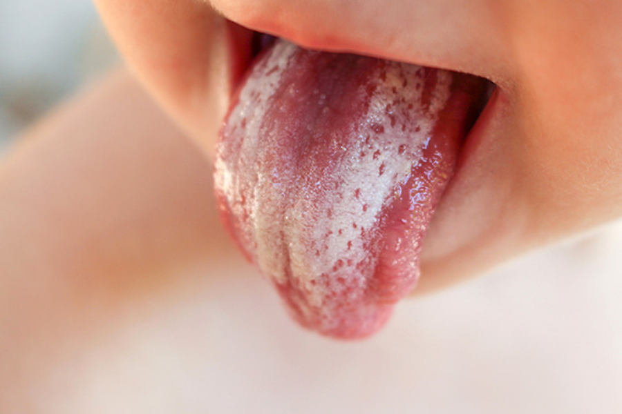 اسباب فطريات الفم واللسان 