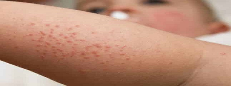 علاج حساسية الجلد المزمنة