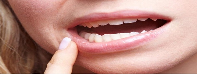 فطريات الفم | طرق علاج الإصابة بفطريات الفم واللسان