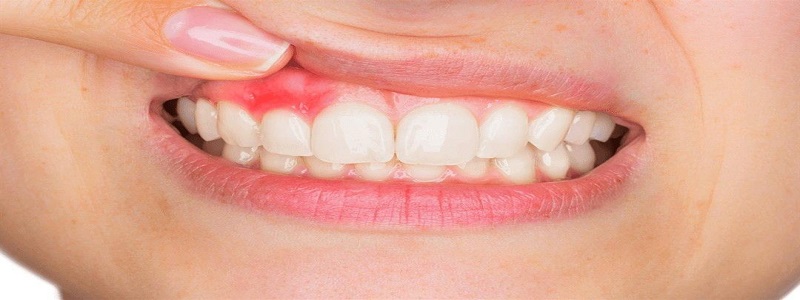 أفضل مضاد حيوي للأسنان ولعلاج اللثة