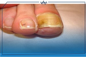 ادوية علاج فطريات الاظافر