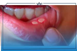 ادوية علاج فطريات الفم