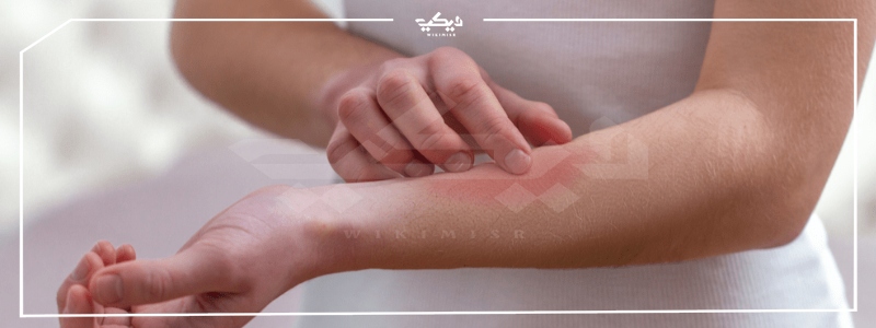 اسماء حقن حساسية الجلد واسعارها وأعراض هذا المرض