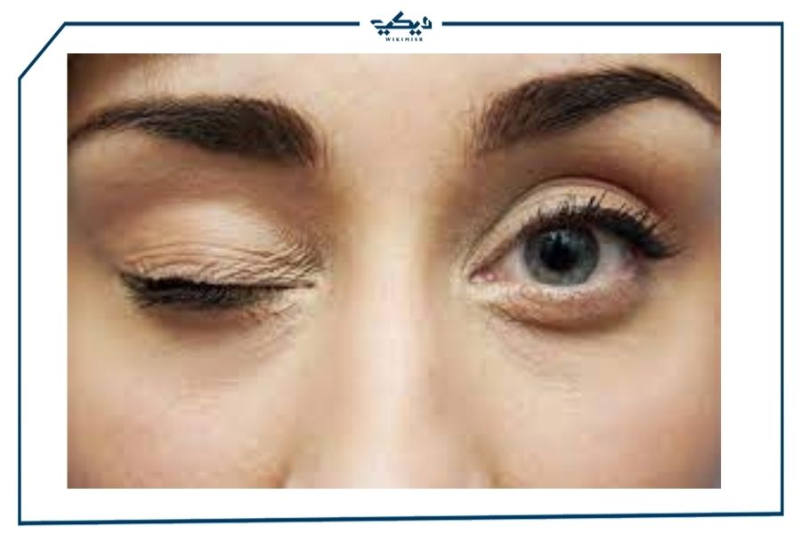 هل هناك علاقة بين رفرفة العين ووجود ألم في منطقة معينة من الرأس؟