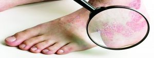 دواء zaro لعلاج مرض الصدفية