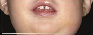 أسرع علاج للنكاف الأعراض والتشخيص