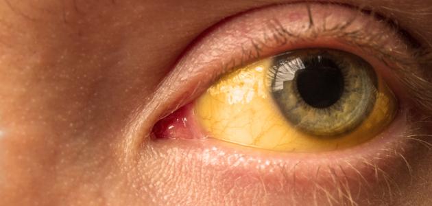 أسباب وطرق علاج اصفرار العين الفعالة