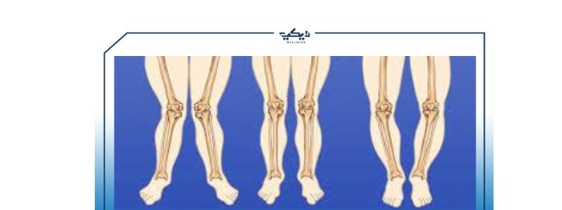 علاج تقوس الساقين بالتمارين والتكلفة