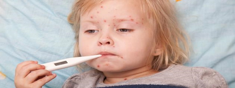 أعراض الحصبة عند الأطفال وتشخيص الإصابة بها