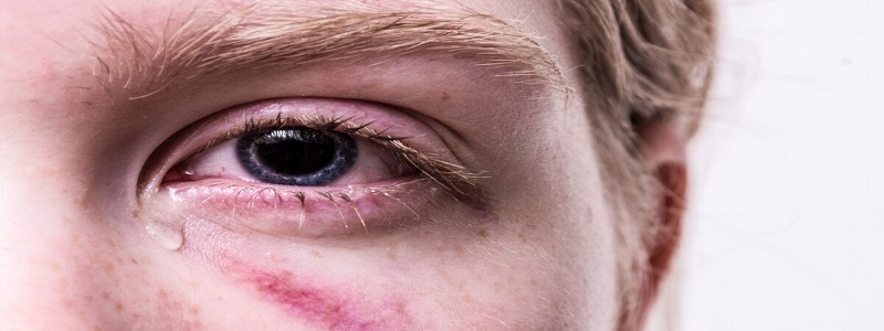 أنواع حساسية العين وأعراضها وطرق علاجها