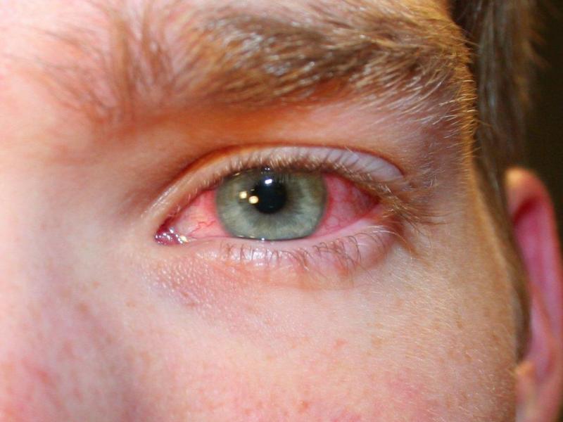 ارتفاع ضغط العين أسبابه وأعراضه الخطيرة