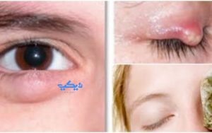 ما سبب تكرار ظهور الكيس الدهني في العين