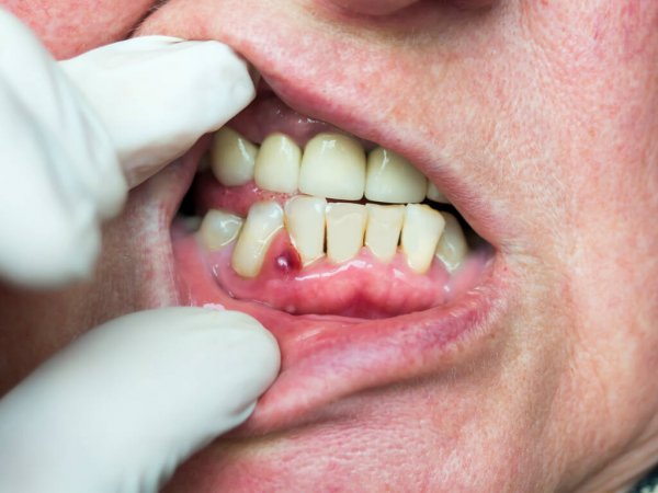 علاج خراج الأسنان وأسبابه وكيفية تجنبه