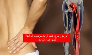 أعراض عرق النسا أو ما يعرف بـ ألم أسفل الظهر فوق المؤخرة