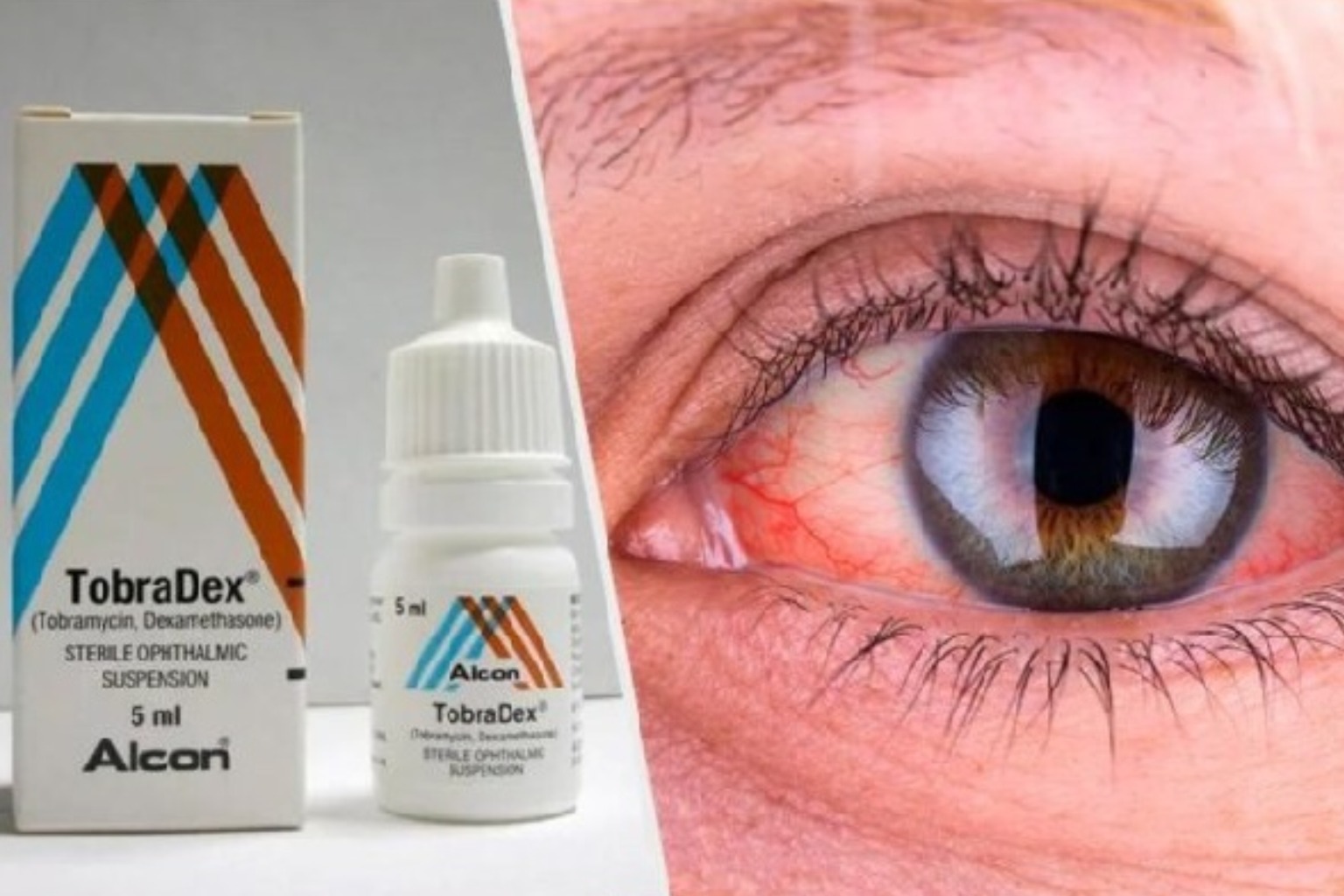 قطرة العين tobradex توبراديكس دواعي الاستعمال الأعراض الجانبية السعر