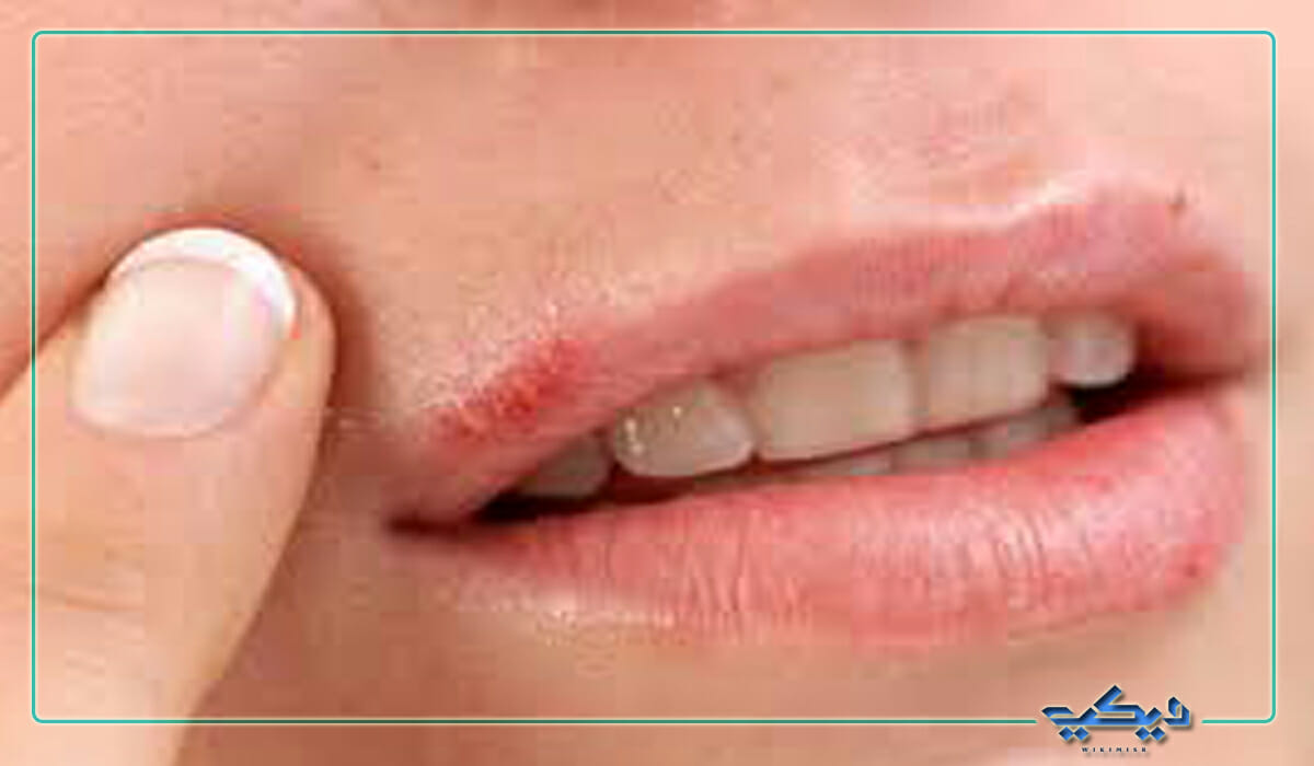 التهاب حول الفم