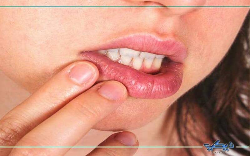سبب التهاب حول الفم وطريقة علاجه وأهم الكريمات