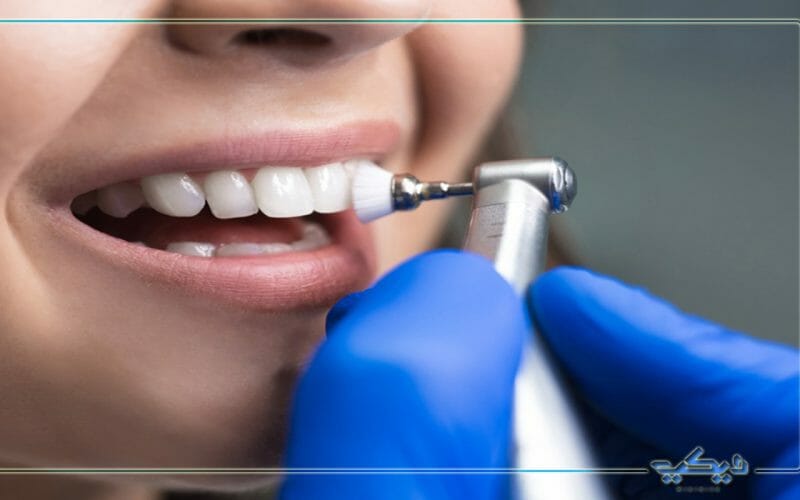 طريقة إزالة جير الأسنان وأضراره