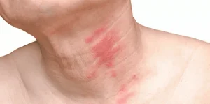 وزارة الصحة السعودية تحذر من أمور تعيد الحزام الناري