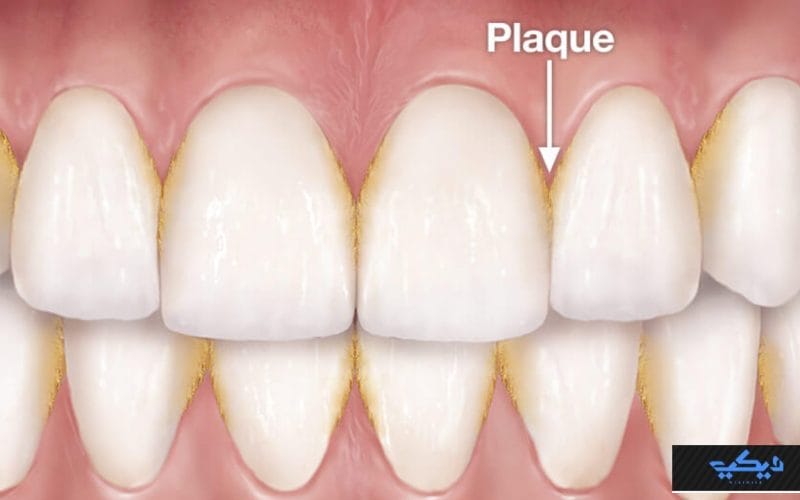 كيف تقضي على طبقة البلاك بفرشاة الأسنان وخيط الأسنان