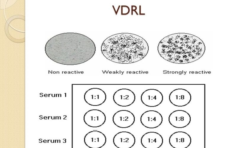 تحليل VDRL وقراءة نتيجة التحليل
